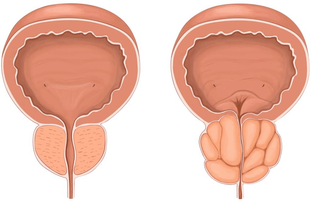 What happens to the prostate in prostatitis