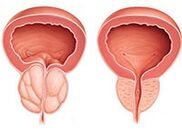 Prostatitis