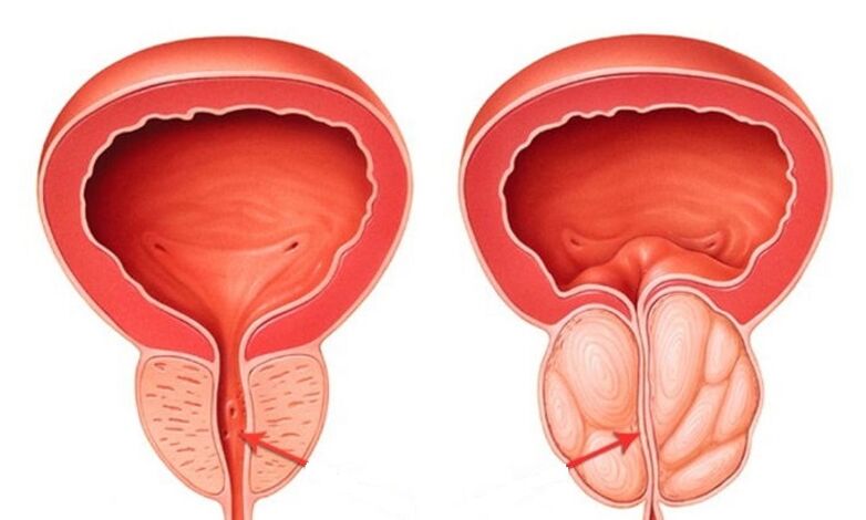 Healthy and inflamed prostate with prostatitis