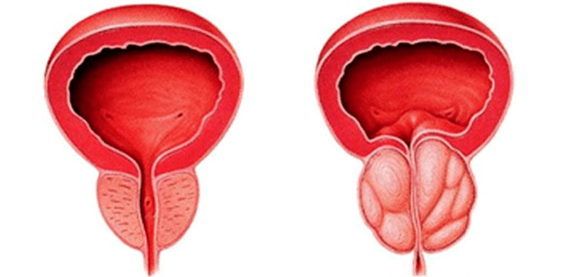 Normal and inflamed prostate